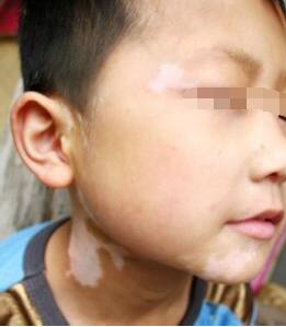 如何预防儿童白癜风扩散
