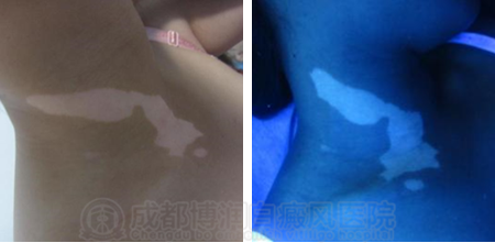 患者颈部白斑治疗前wood灯下可以看到白斑色素脱失明显