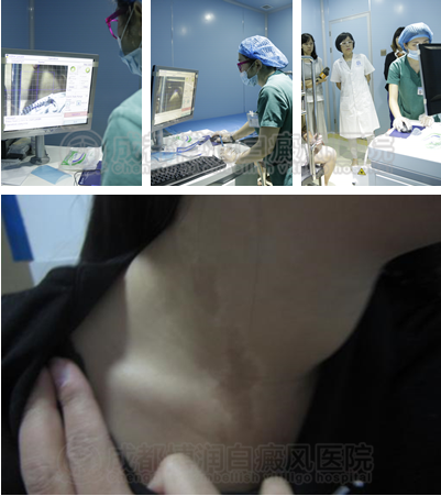 经过智能308治疗后白斑已经完全恢复