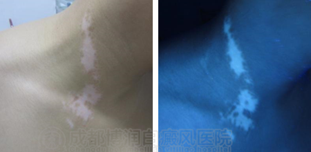 经过一个月智能308光疗后可以看出白斑处黑色素已经慢慢长出来