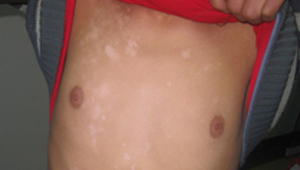 胸部白癜风的病因是什么