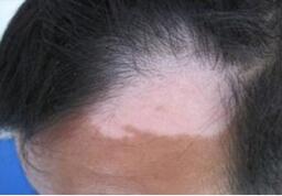 头部白癜风的危害有哪些