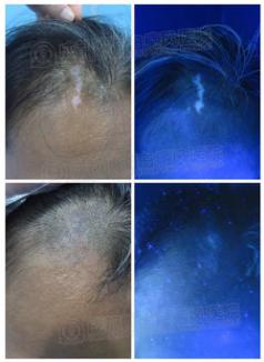 姚金兰(化名)治疗前后对比图