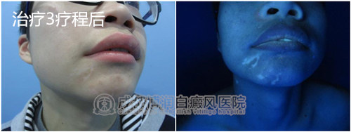 治疗3个疗程后,白斑进入稳定期,白斑面积缩小.jpg