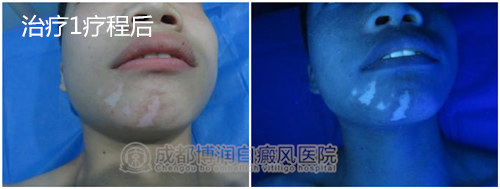 治疗1疗程后,边缘色素加深