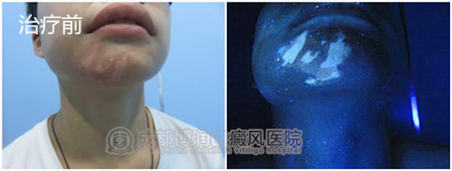 wood灯检查白斑范围