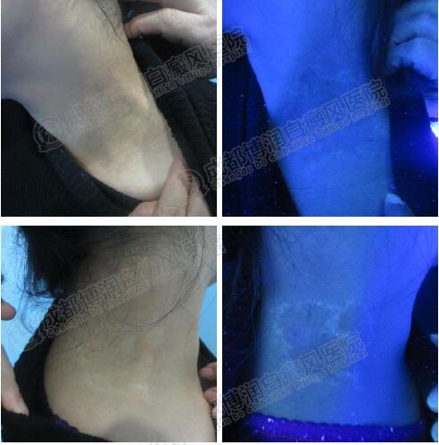 疗程结束患处肤色恢复与正常无异wood灯检查患处黑色素生成良好