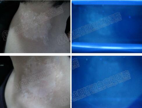 治疗一段时间后wood灯检查患处黑色素生成程度