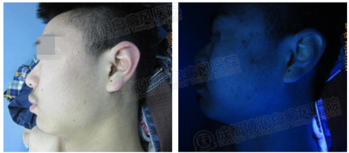 治疗一个多月后,白斑已消失无踪