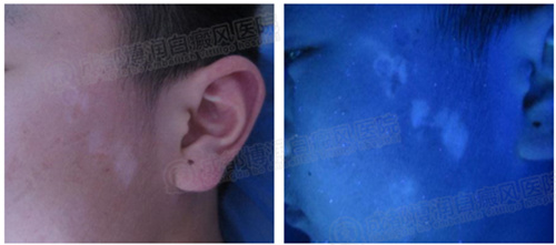 wood灯检查白斑色素脱失