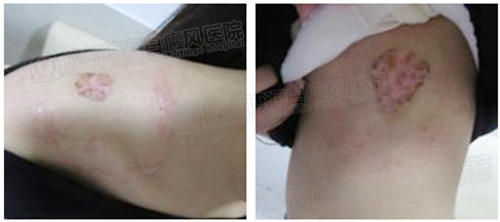 第二疗程:表皮移植治疗快速生成黑色素