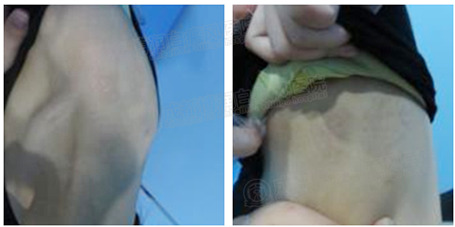 第三疗程:巩固疗效防复发