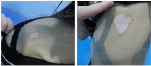 疗程:利用光疗、中药等稳定白斑不在发展