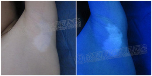 wood灯下白斑状态