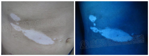 寻常型散发性白癜风