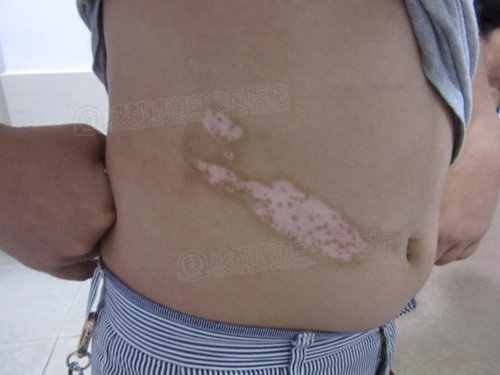 疗程后,白斑处出现色素点