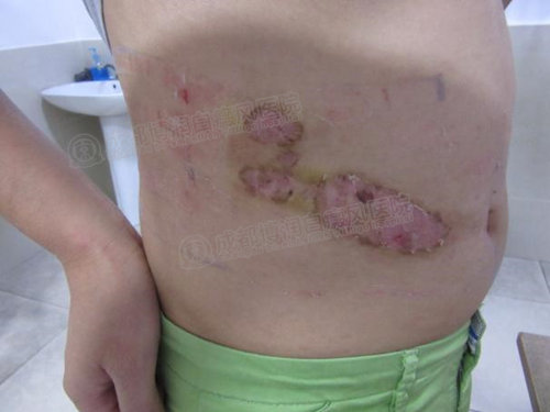 手术治疗后,黑色素大量生成