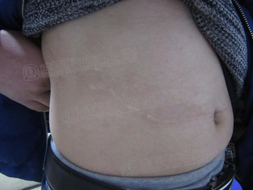 愈后康复良好,现定期复诊抗复发治疗