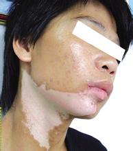 成都治疗白癜风较好的医院