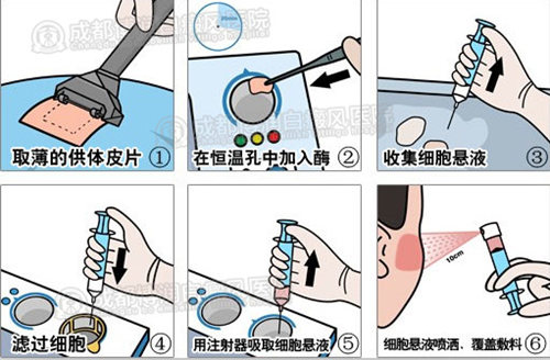 Recell分离治疗操作流程