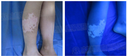 wood灯鉴别黑色素脱失症状