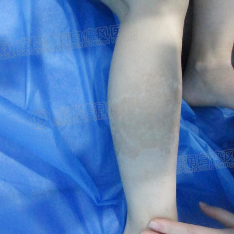 愈后效果良好,白斑基本消失