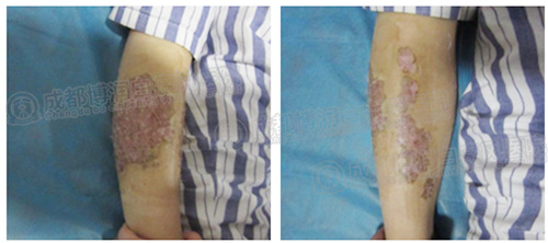 表皮移植术后一周