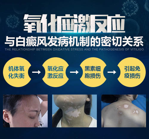氧化应激与白癜风的相关性研究