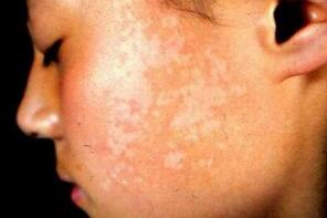 头部白癜风如何护理效果好