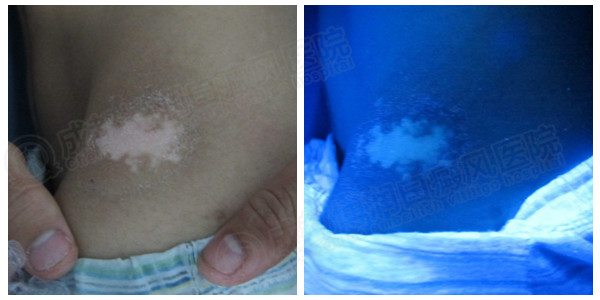 寻常型散发性白癜风