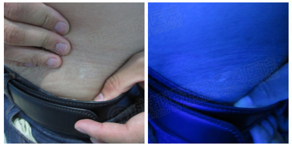 来院复诊wood灯显示腰部白斑已经完全恢复