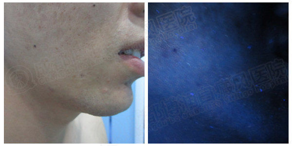 来院复诊wood灯显示面部白斑已经完全恢复