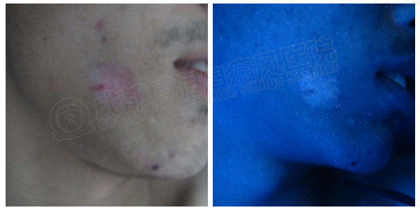 Wood灯检查下面部白斑色素脱失明显