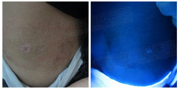 治疗中的腰部白斑wood灯显示恢复良好