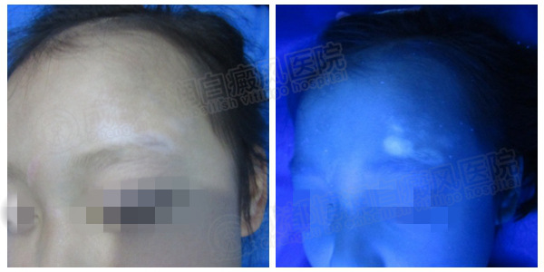 Wood灯检查下面部白斑色素脱失明显