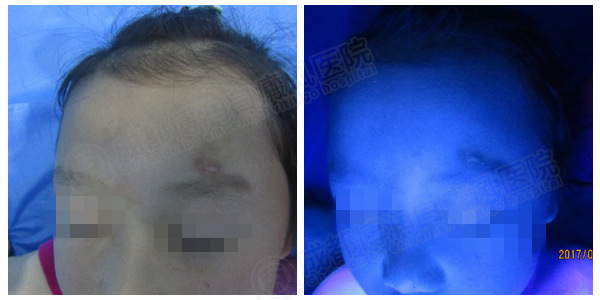 治疗中媛媛(化名)面部白斑wood灯显示恢复良好