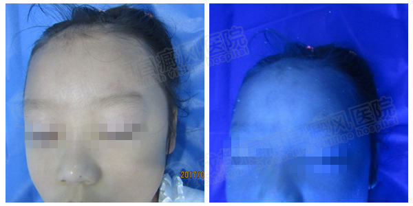 复诊时wood灯显示媛媛(化名)面部白斑已经完全恢复