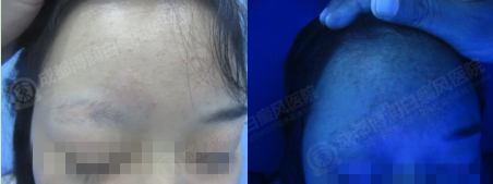 治疗两个月左右白斑基本消失