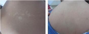 腰部白癜风护理方面要注意什么