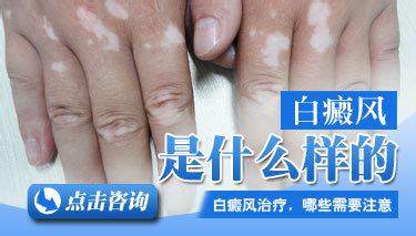 早期白癜风具体有哪些症状