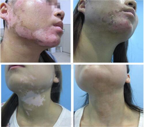 我院“2000例白癜风临床治疗案例”康复图例