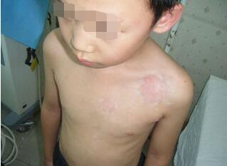 引发儿童白癜风的原因有哪些