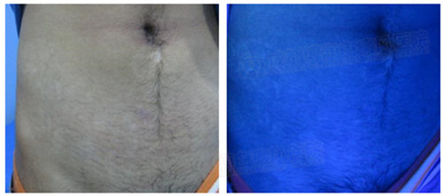 治疗后,白斑基本恢复正常肤色