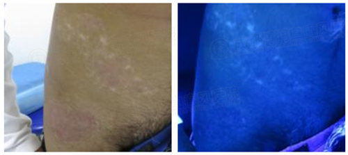 治疗中,黑色素大量生成