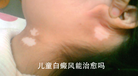 儿童白癜风怎么回事