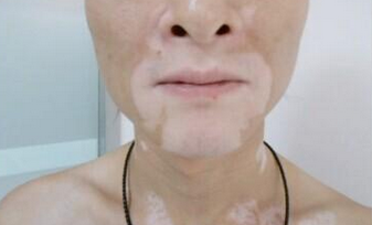 春季白癜风为何易复发