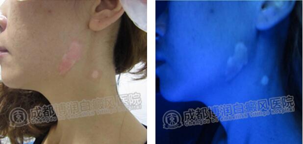 治疗前,杨涛的颈部白斑很吓人