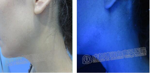 三个月后,杨涛的白斑康复了