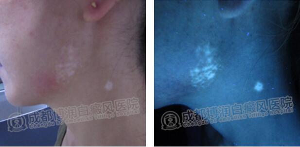 一个月后,杨涛的白斑消失了很多