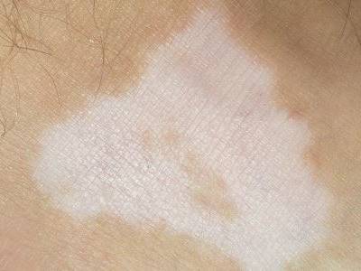 成都较好的白癜风医院:治疗白癜风要注意什么